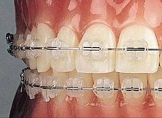 Ortodoncia metálica
