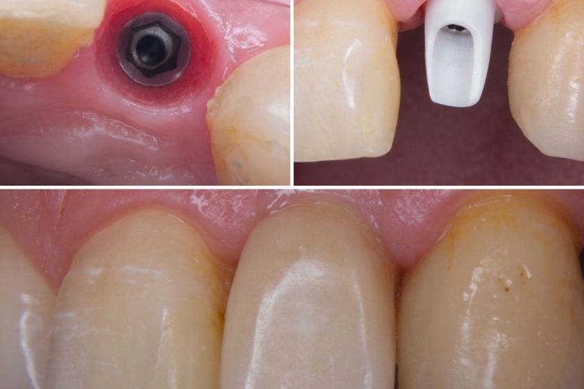 Implantes dentales antes y después - 641659