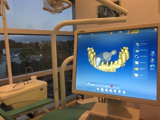 Diseño de carillas de porcelana con sistema CAD CAM