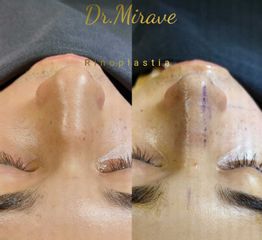 Rinoplastia - Dr. Gabriel Mirave
