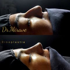 Rinoplastia - Dr. Gabriel Mirave