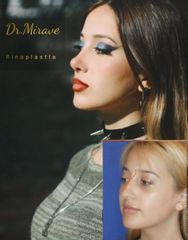 Rinoplastia - Dr. Gabriel Mirave