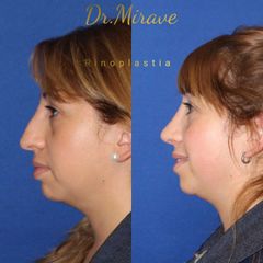 Rinoplastia - Dr. Gabriel Mirave