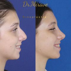 Rinoplastia - Dr. Gabriel Mirave