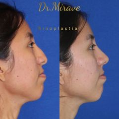 Rinoplastia - Dr. Gabriel Mirave