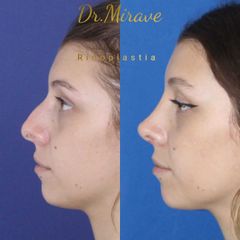 Rinoplastia - Dr. Gabriel Mirave