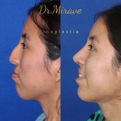 Rinoplastia - Dr. Gabriel Mirave