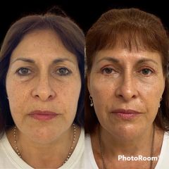 blefaroplastia