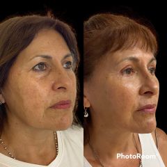 blefaroplastia