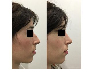 Rinoplastia