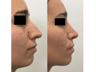 Rinoplastia