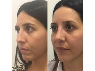 Rinoplastia