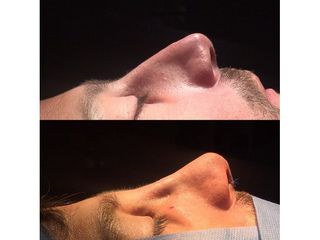 Rinoplastia - Dr. Ignacio Amado