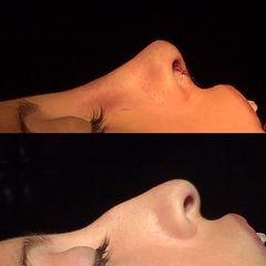 Rinoplastia - Dr. Ignacio Amado