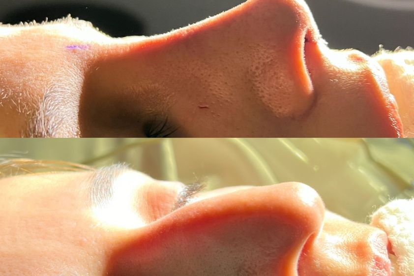 Rinoplastia antes y después - 850594