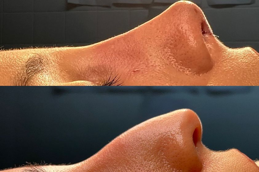 Rinoplastia antes y después - 850596