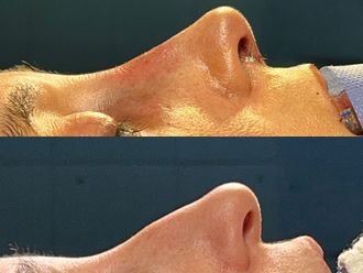 Rinoplastia antes y después - 876356