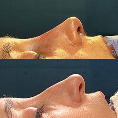 Rinoplastia - Dr. Ignacio Amado