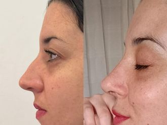 Rinoplastia antes y después - 876357