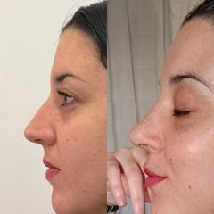 Rinoplastia - Dr. Ignacio Amado