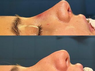Rinoplastia antes y después - 876358