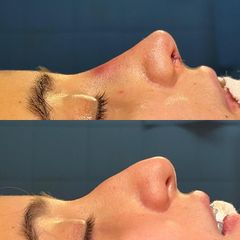 Rinoplastia - Dr. Ignacio Amado