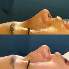 Rinoplastia - Dr. Ignacio Amado