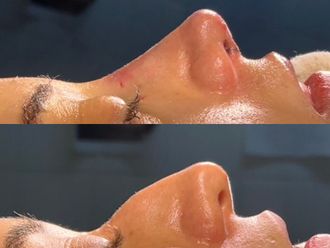 Rinoplastia antes y después - 878483
