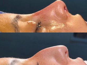 Rinoplastia antes y después - 878484