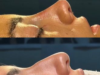 Rinoplastia antes y después - 878485