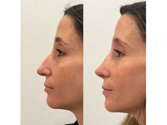 Rinoplastia antes y después - 878540