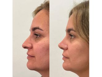 Rinoplastia antes y después - 878541
