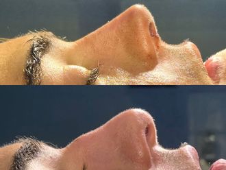 Rinoplastia antes y después - 878611