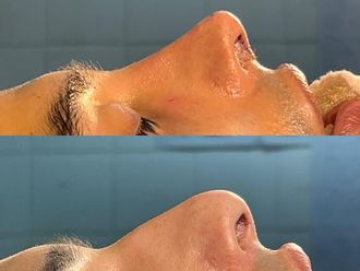 Rinoplastia antes y después - 878624
