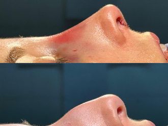 Rinoplastia antes y después - 878854