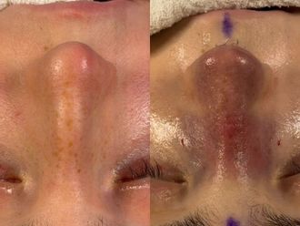 Rinoplastia antes y después - 879850