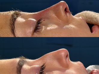 Rinoplastia antes y después - 879851