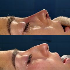 Rinoplastia - Dr. Ignacio Amado