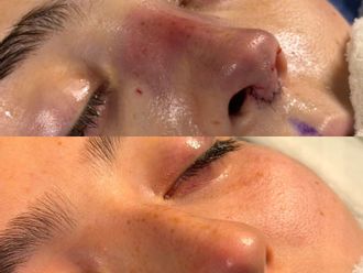 Rinoplastia antes y después - 879852