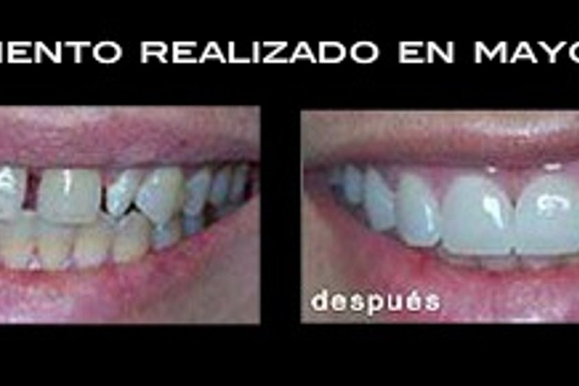 Carillas dentales antes y después - 275589