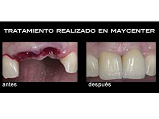 Implantes dentales