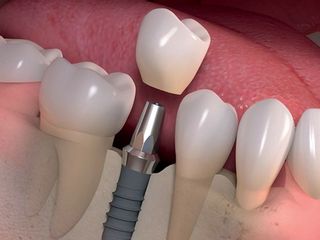 Especialistas en Implantes Dentales
