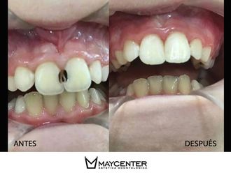 Prótesis dentales - 590310