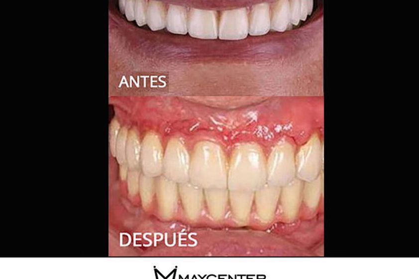 Implantes dentales antes y después - 590314