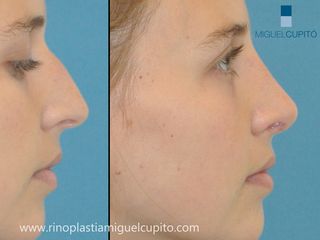 Rinoplastia Dr Miguel Cupito