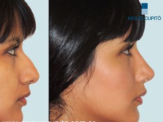 Rinoplastia Dr Miguel Cupito 