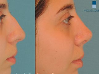 Rinoplastia Dr Miguel Cupito