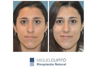 Rinoplastia - Dr. Miguel Angel Cupido