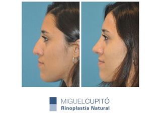 Rinoplastia - Dr. Miguel Angel Cupido