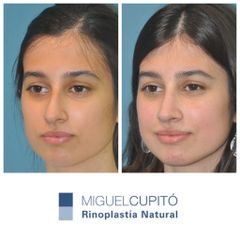 Rinoplastia - Dr. Miguel Ángel Cupito